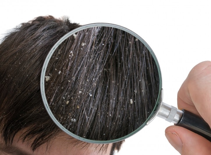 “The claim ‘anti-dandruff’ (next to brand awareness) will be a main driver for buying decisions which highlights the importance of the use of trusted, monographed ingredients to convince the consumer to purchase,” said Sabrina Behnke, PhD, Associate Business Director at Tri-K Industries. © vchal Getty Images