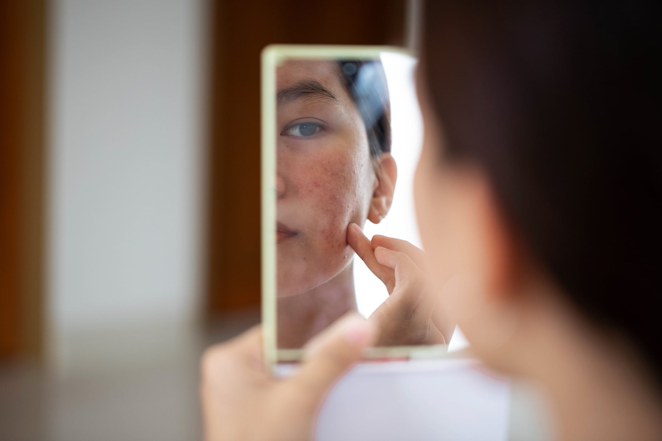 Asian girl with acne scars