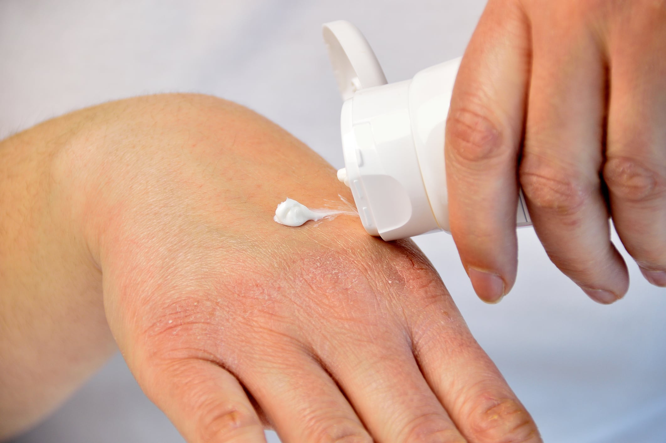 Probiotic skin therapy improves eczema in children, says pilot study