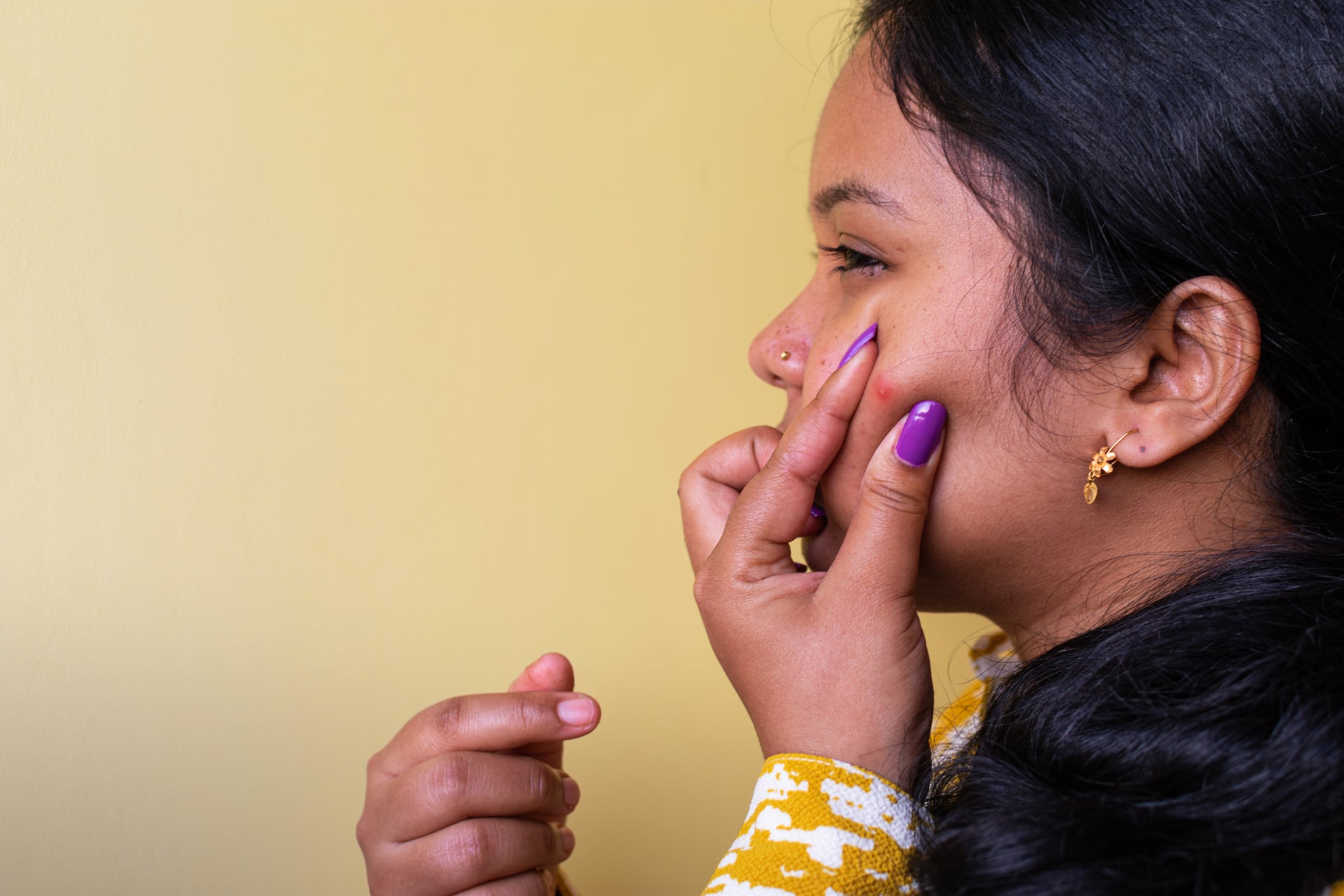 Adult acne woes: Biochemical and hormonal abnormalities found to cause adult female acne