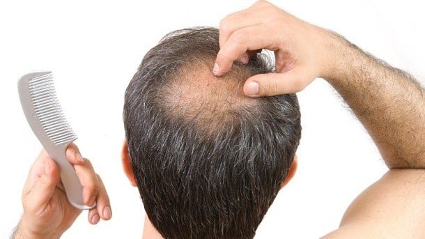 Balding.jpg