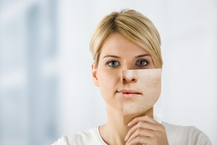 L-Oreal-patent-on-acne-facial-imaging-technology-for-product-recommendations.jpg