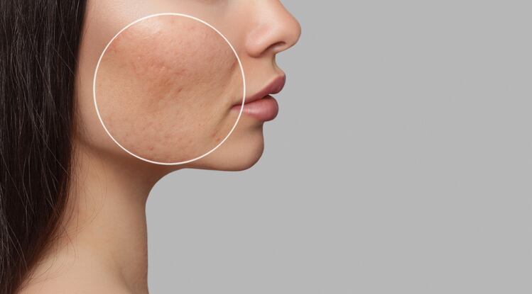 Kimchi-isolated-probiotic-strain-supplementation-reduces-acne-severity-CJ-Foods-12-week-RCT.png