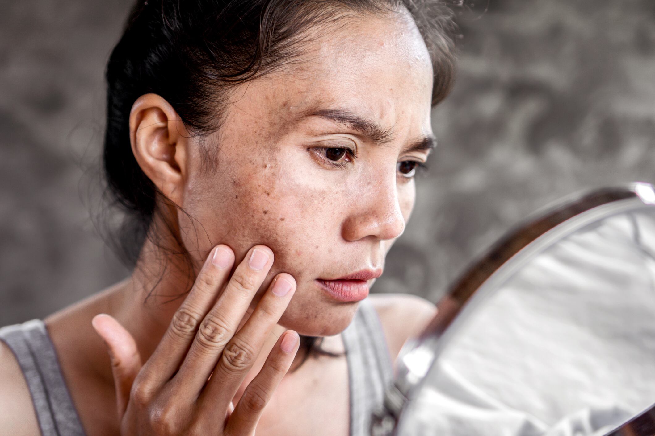 Grape-derived supplement shows efficacy to lighten dark spots 