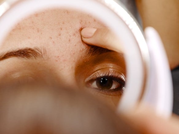 Bacteriophage-therapy-for-acne-and-blemish-prone-skin-promising-says-supplier-Biocogent.jpg
