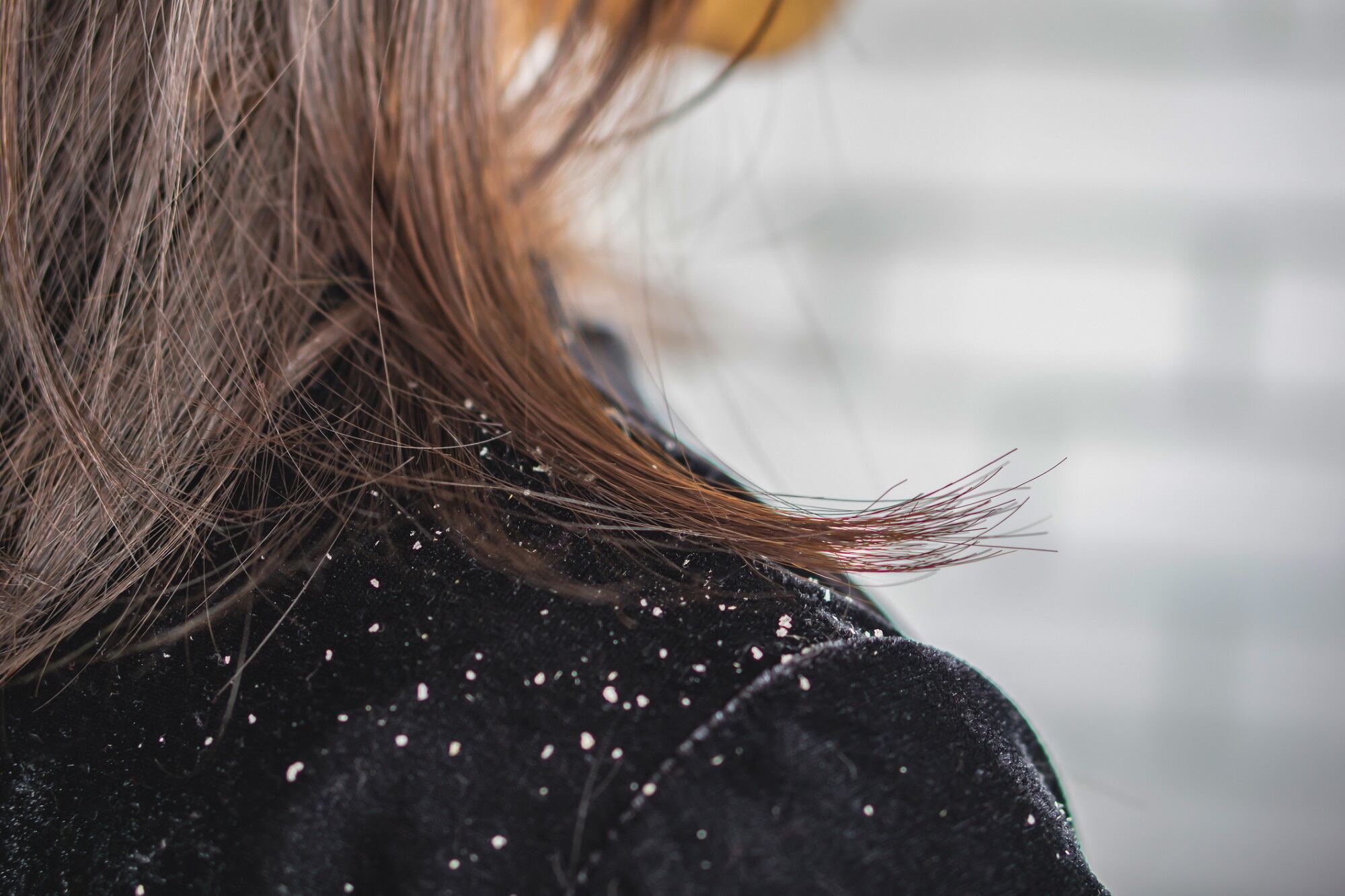 Study-finds-paraprobiotic-may-solve-dandruff.jpg
