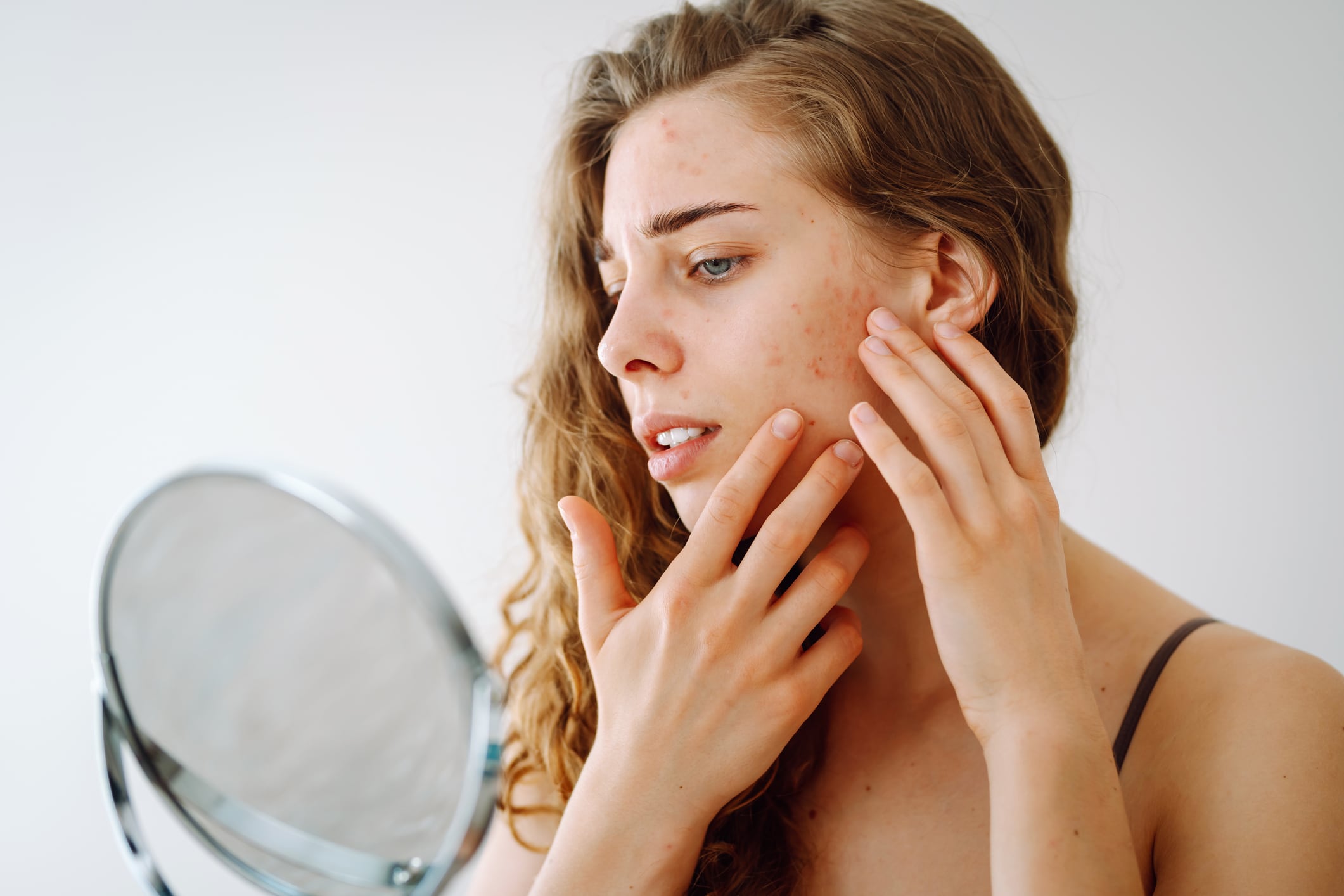 Innovating to target adult acne 