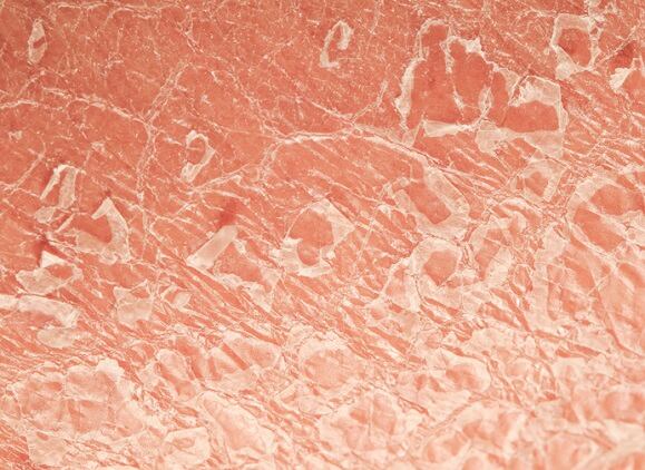 Probiotics can treat psoriasis, shows new clinical data from ADM