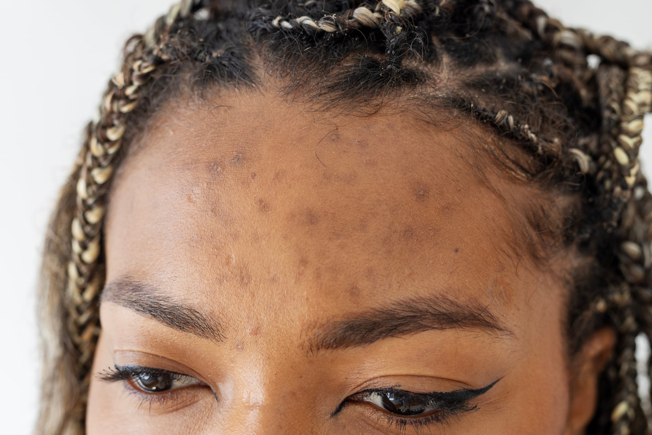 Study: Jellybush honey extract reduces acne scars across skin tones