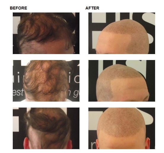 Hair-loss.jpg