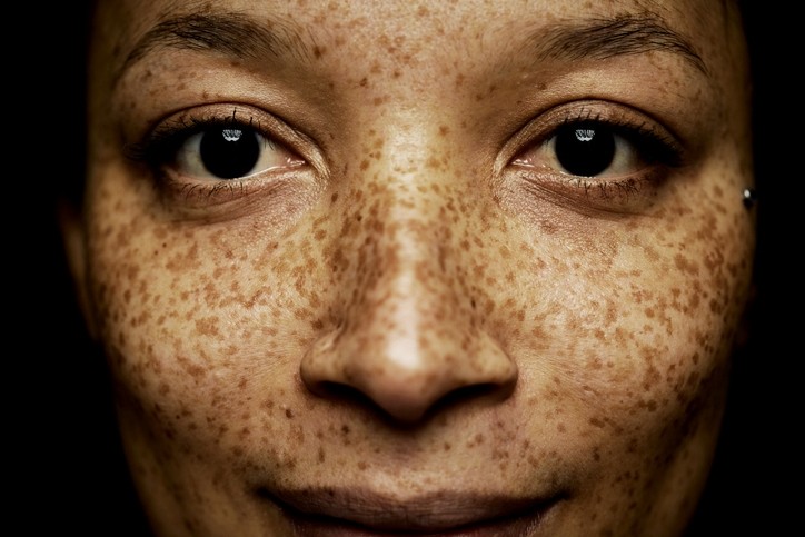 Standardisation in study designs, sample collection and processing as well as data analysis will help advance knowledge in the skin microbiome worldwide [Getty Images]