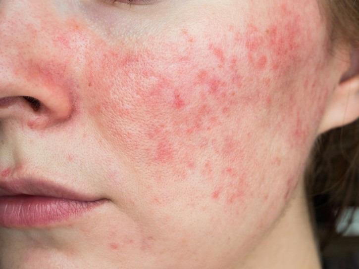 The application process is now open for interested industry manufacturers and suppliers seeking to market products specifically to those struggling with rosacea symptoms. © Yuliya Shauerman Getty Images