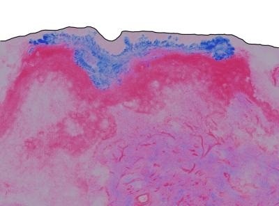 ZnO nanoparticle distribution in excised human skin. Black line represents the surface of skin (top), blue represents ZnO nanoparticle distribution in skin (stratum corneum), and pink represents skin