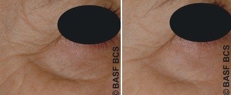 Before and after shot of volunteer's crows feet