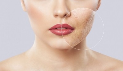 Pyruvic acid peel a promising procedure to treat acne vulgaris - new research